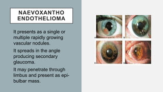 NAEVOXANTHO
ENDOTHELIOMA
It presents as a single or
multiple rapidly growing
vascular nodules.
It spreads in the angle
producing secondary
glaucoma.
It may penetrate through
limbus and present as epi-
bulbar mass.
 