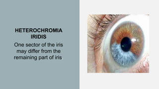 HETEROCHROMIA
IRIDIS
One sector of the iris
may differ from the
remaining part of iris.
 