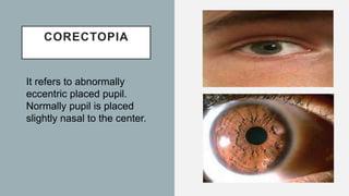CORECTOPIA
It refers to abnormally
eccentric placed pupil.
Normally pupil is placed
slightly nasal to the center.
 