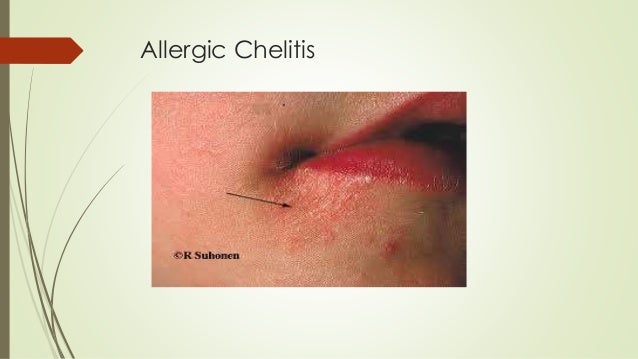 lip diseases