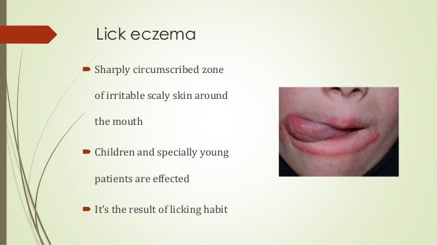 How do you treat eczema on the lips?