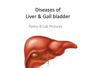 Diseases of Liver & Gall bladder Patho-B Lab Pictures 