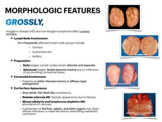 Diseases of Lymph node & Spleen - Pathology | PDF