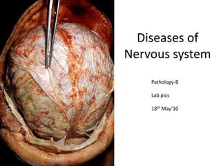 Diseases of Nervous system Pathology-B  Lab pics 18th May’10 