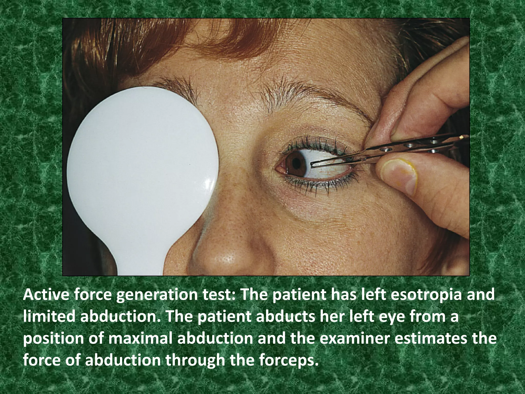 Active force generation test: The patient has left esotropia and
limited abduction. The patient abducts her left eye from a
position of maximal abduction and the examiner estimates the
force of abduction through the forceps.

 