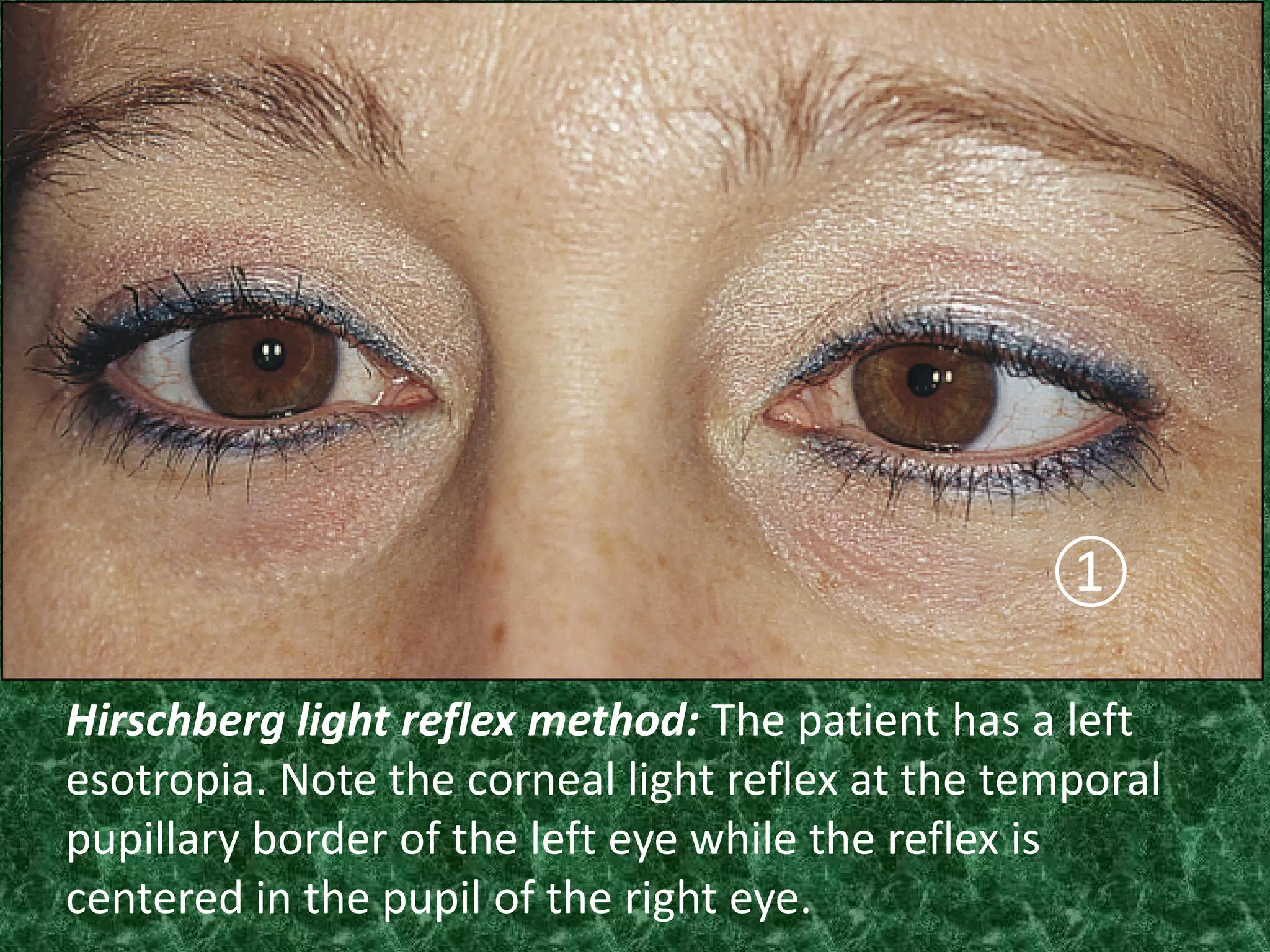 ①
Hirschberg light reflex method: The patient has a left
esotropia. Note the corneal light reflex at the temporal
pupillary border of the left eye while the reflex is
centered in the pupil of the right eye.

 