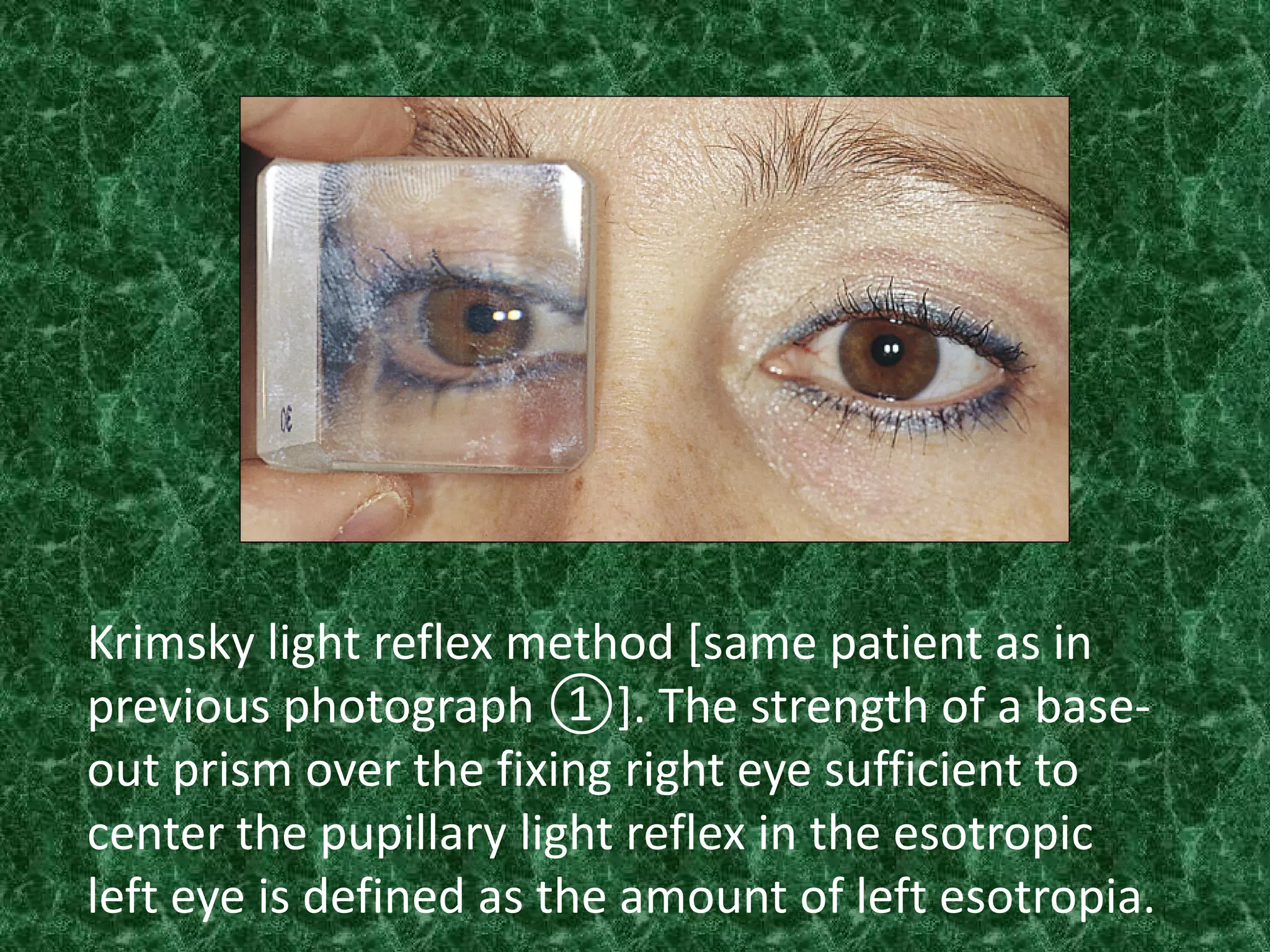 Krimsky light reflex method [same patient as in
previous photograph ①]. The strength of a baseout prism over the fixing right eye sufficient to
center the pupillary light reflex in the esotropic
left eye is defined as the amount of left esotropia.

 