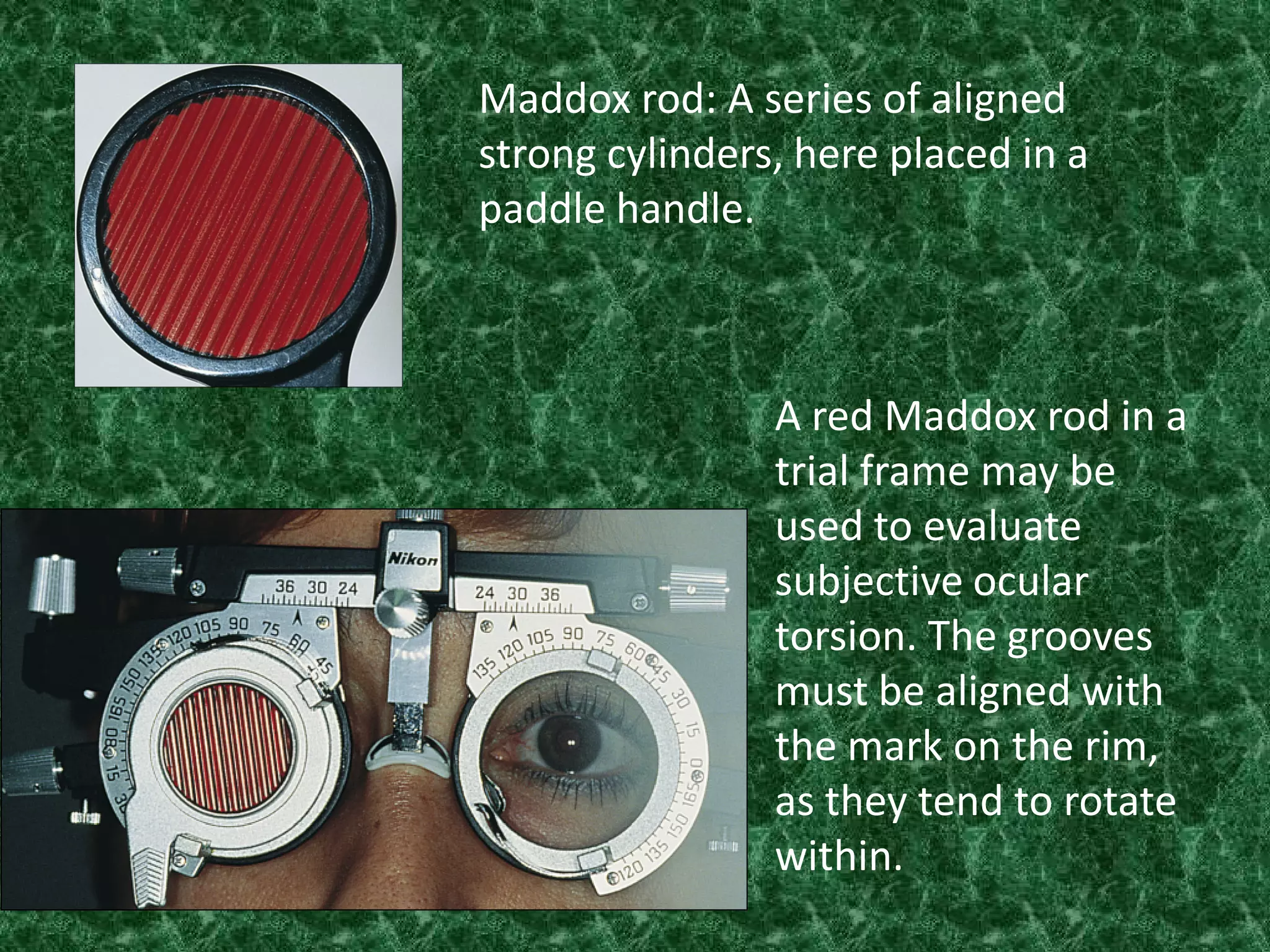 Maddox rod: A series of aligned
strong cylinders, here placed in a
paddle handle.

A red Maddox rod in a
trial frame may be
used to evaluate
subjective ocular
torsion. The grooves
must be aligned with
the mark on the rim,
as they tend to rotate
within.

 