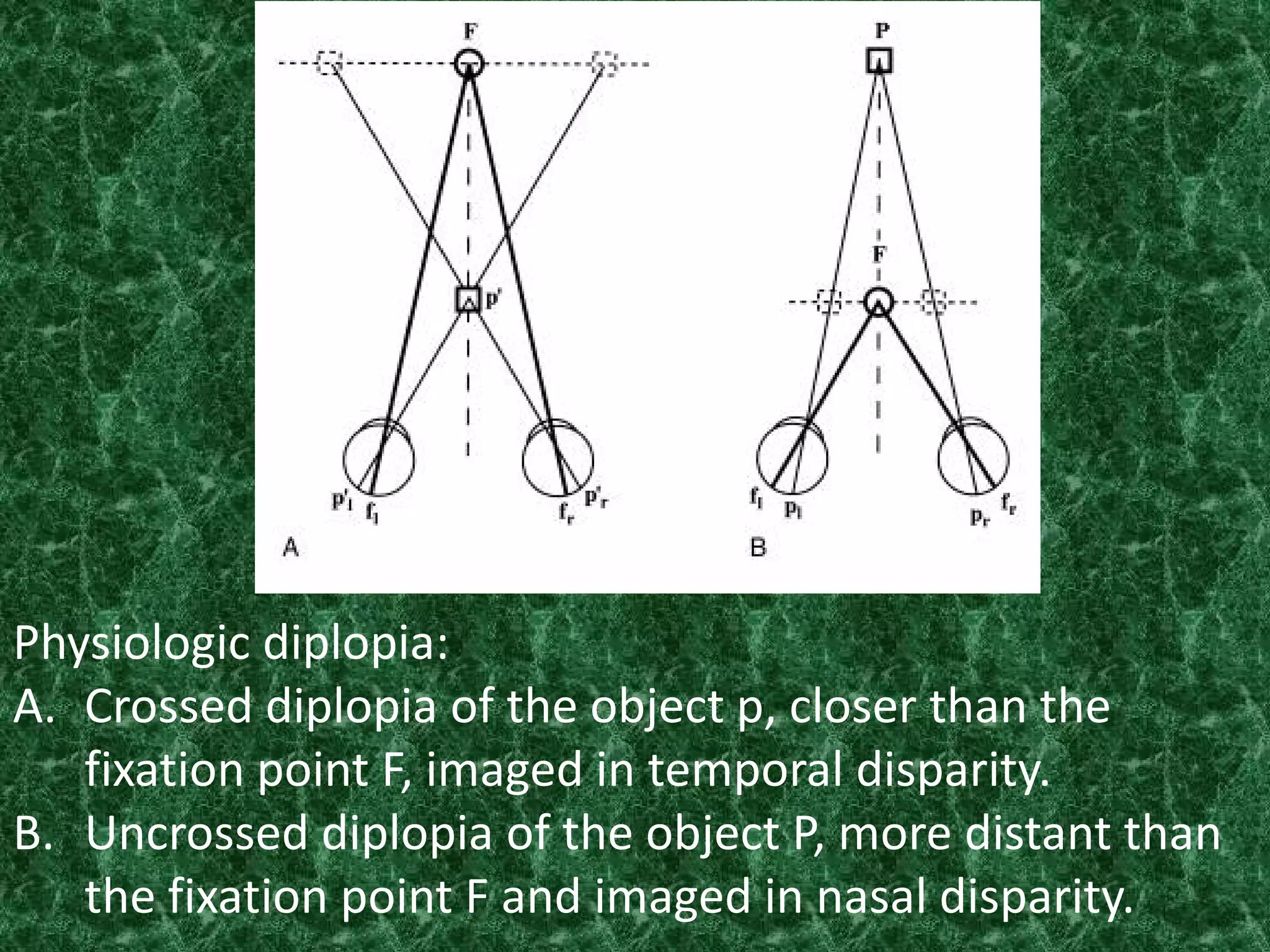 Physiologic diplopia:
A. Crossed diplopia of the object p, closer than the
fixation point F, imaged in temporal disparity.
B. Uncrossed diplopia of the object P, more distant than
the fixation point F and imaged in nasal disparity.

 