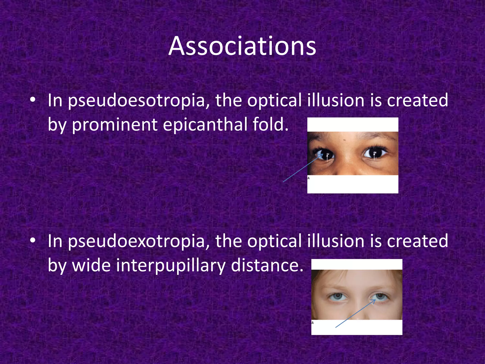 Associations
• In pseudoesotropia, the optical illusion is created
by prominent epicanthal fold.

• In pseudoexotropia, the optical illusion is created
by wide interpupillary distance.

 