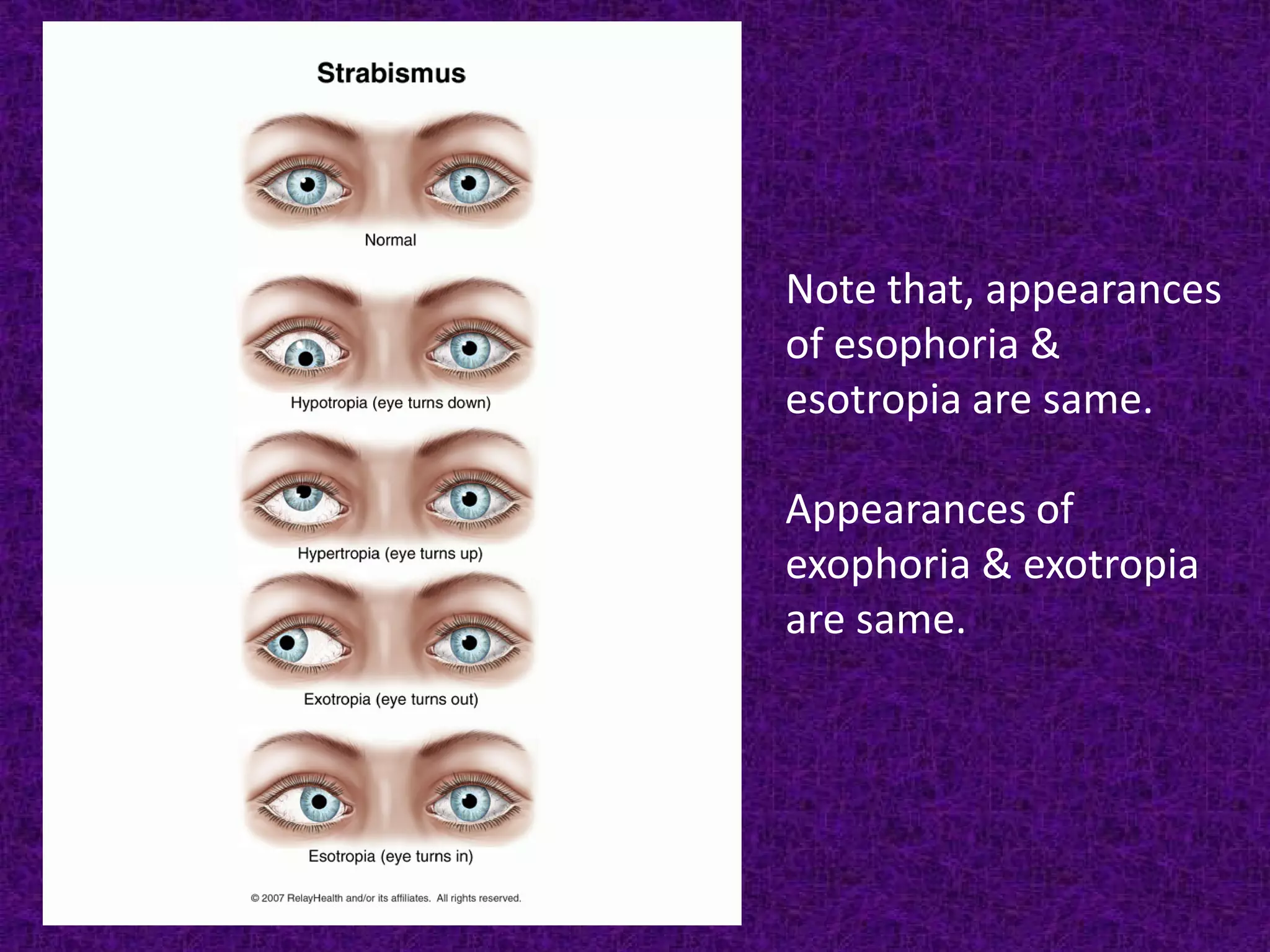 Note that, appearances
of esophoria &
esotropia are same.
Appearances of
exophoria & exotropia
are same.

 