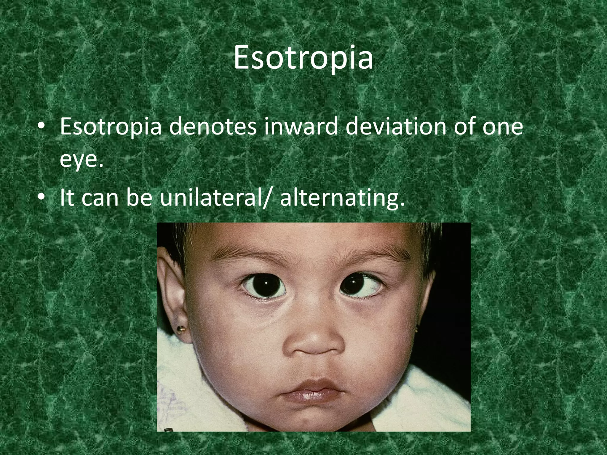 Esotropia
• Esotropia denotes inward deviation of one
eye.
• It can be unilateral/ alternating.

 
