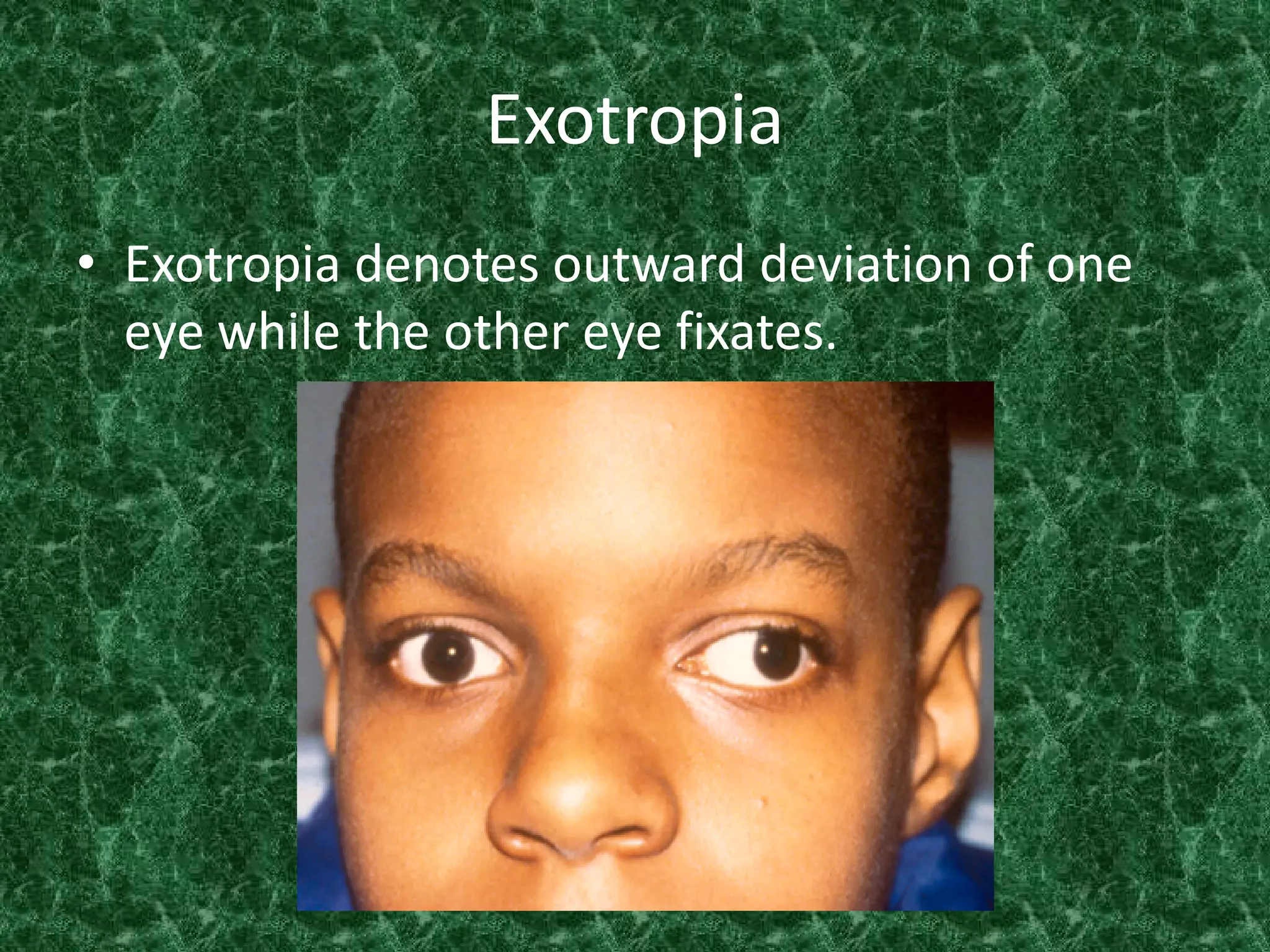 Exotropia
• Exotropia denotes outward deviation of one
eye while the other eye fixates.

 