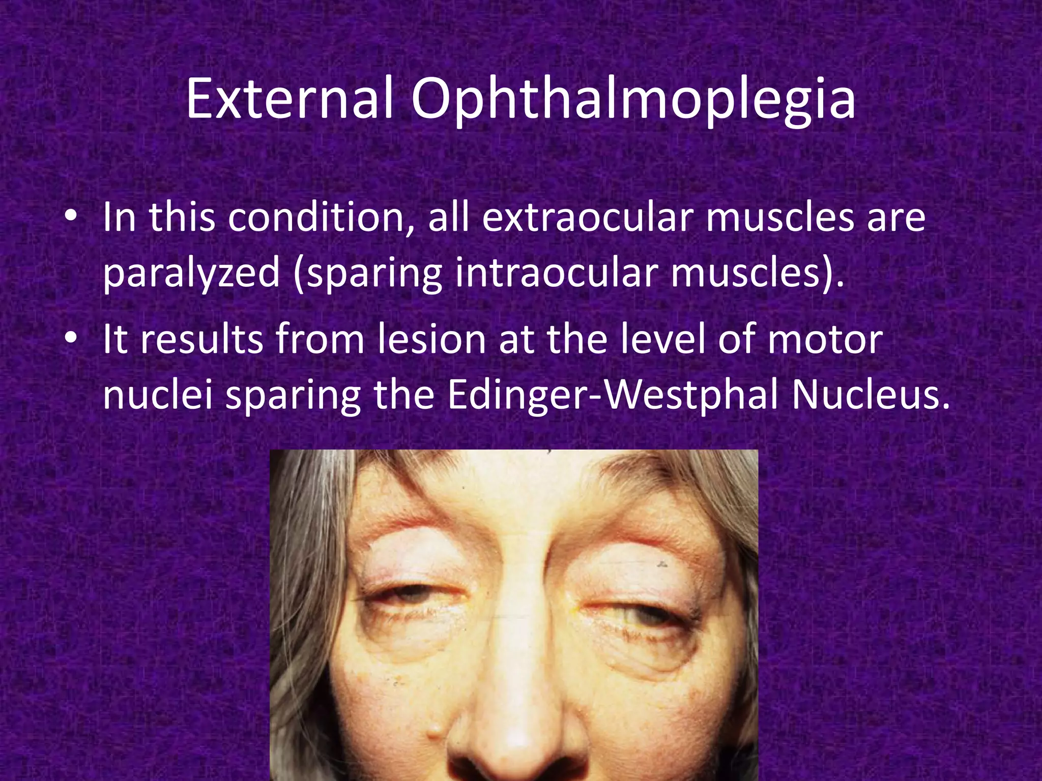 External Ophthalmoplegia
• In this condition, all extraocular muscles are
paralyzed (sparing intraocular muscles).
• It results from lesion at the level of motor
nuclei sparing the Edinger-Westphal Nucleus.

 