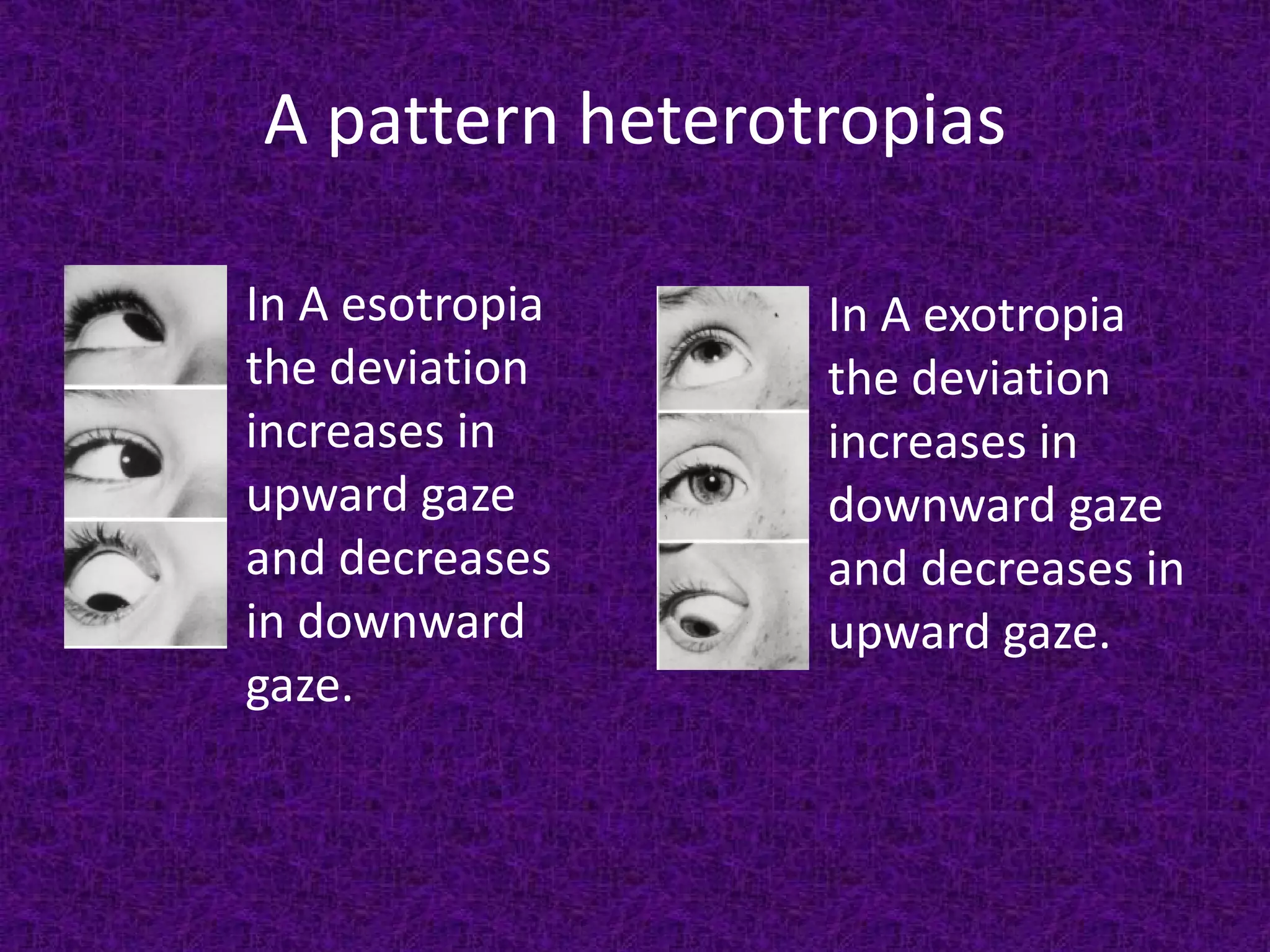 A pattern heterotropias
In A esotropia
the deviation
increases in
upward gaze
and decreases
in downward
gaze.

In A exotropia
the deviation
increases in
downward gaze
and decreases in
upward gaze.

 
