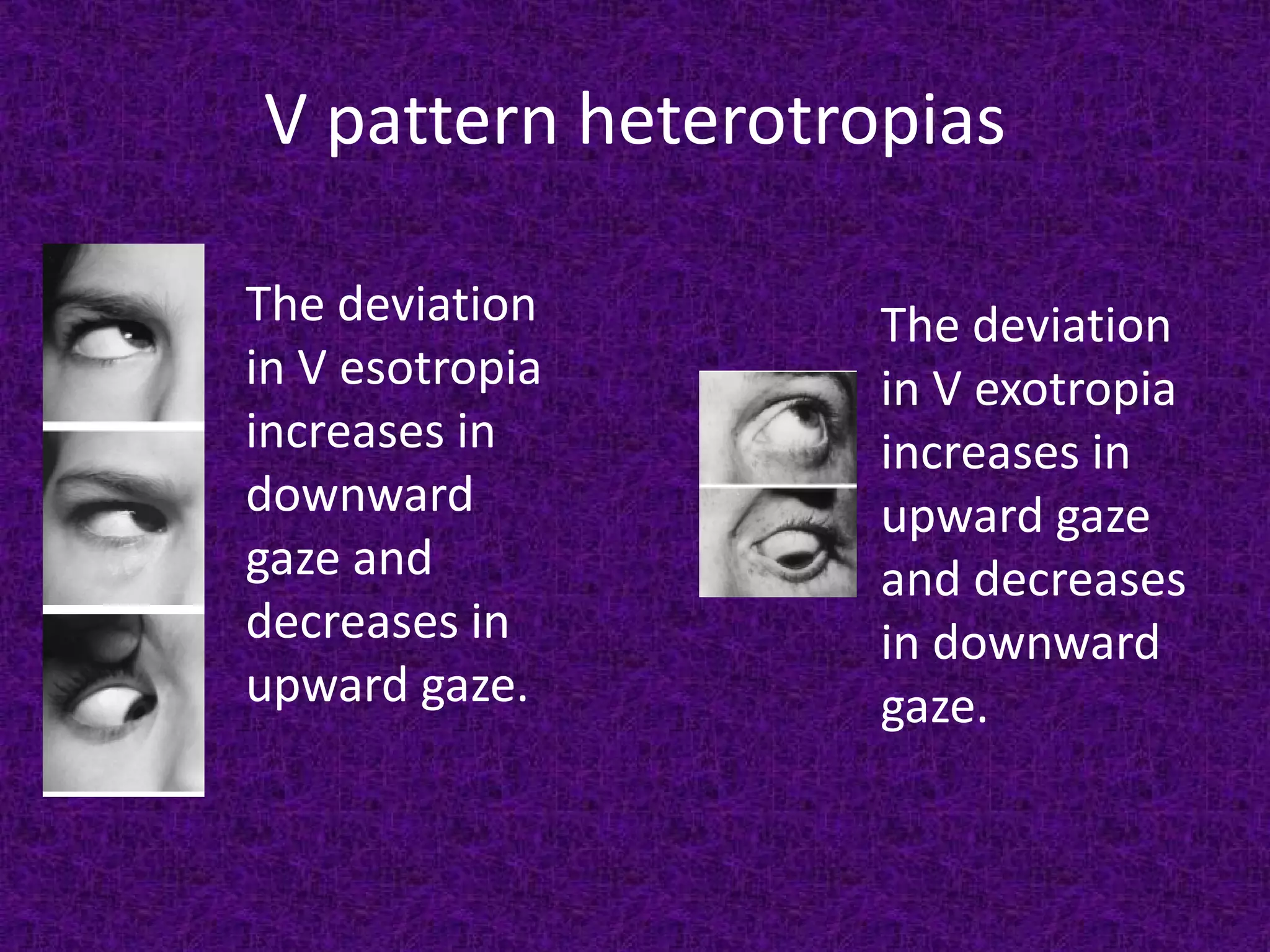 V pattern heterotropias
The deviation
in V esotropia
increases in
downward
gaze and
decreases in
upward gaze.

The deviation
in V exotropia
increases in
upward gaze
and decreases
in downward
gaze.

 