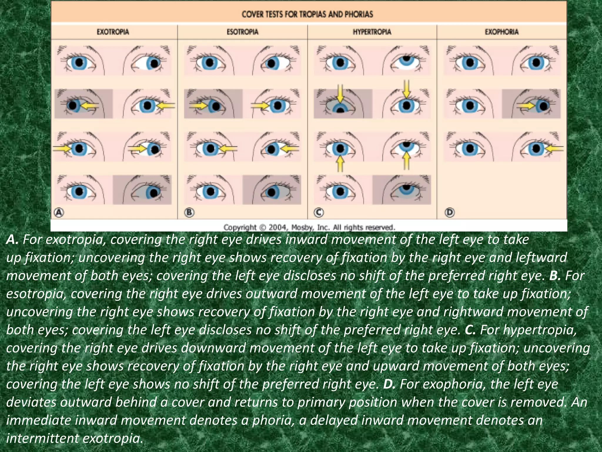 A. For exotropia, covering the right eye drives inward movement of the left eye to take
up fixation; uncovering the right eye shows recovery of fixation by the right eye and leftward
movement of both eyes; covering the left eye discloses no shift of the preferred right eye. B. For
esotropia, covering the right eye drives outward movement of the left eye to take up fixation;
uncovering the right eye shows recovery of fixation by the right eye and rightward movement of
both eyes; covering the left eye discloses no shift of the preferred right eye. C. For hypertropia,
covering the right eye drives downward movement of the left eye to take up fixation; uncovering
the right eye shows recovery of fixation by the right eye and upward movement of both eyes;
covering the left eye shows no shift of the preferred right eye. D. For exophoria, the left eye
deviates outward behind a cover and returns to primary position when the cover is removed. An
immediate inward movement denotes a phoria, a delayed inward movement denotes an
intermittent exotropia.

 