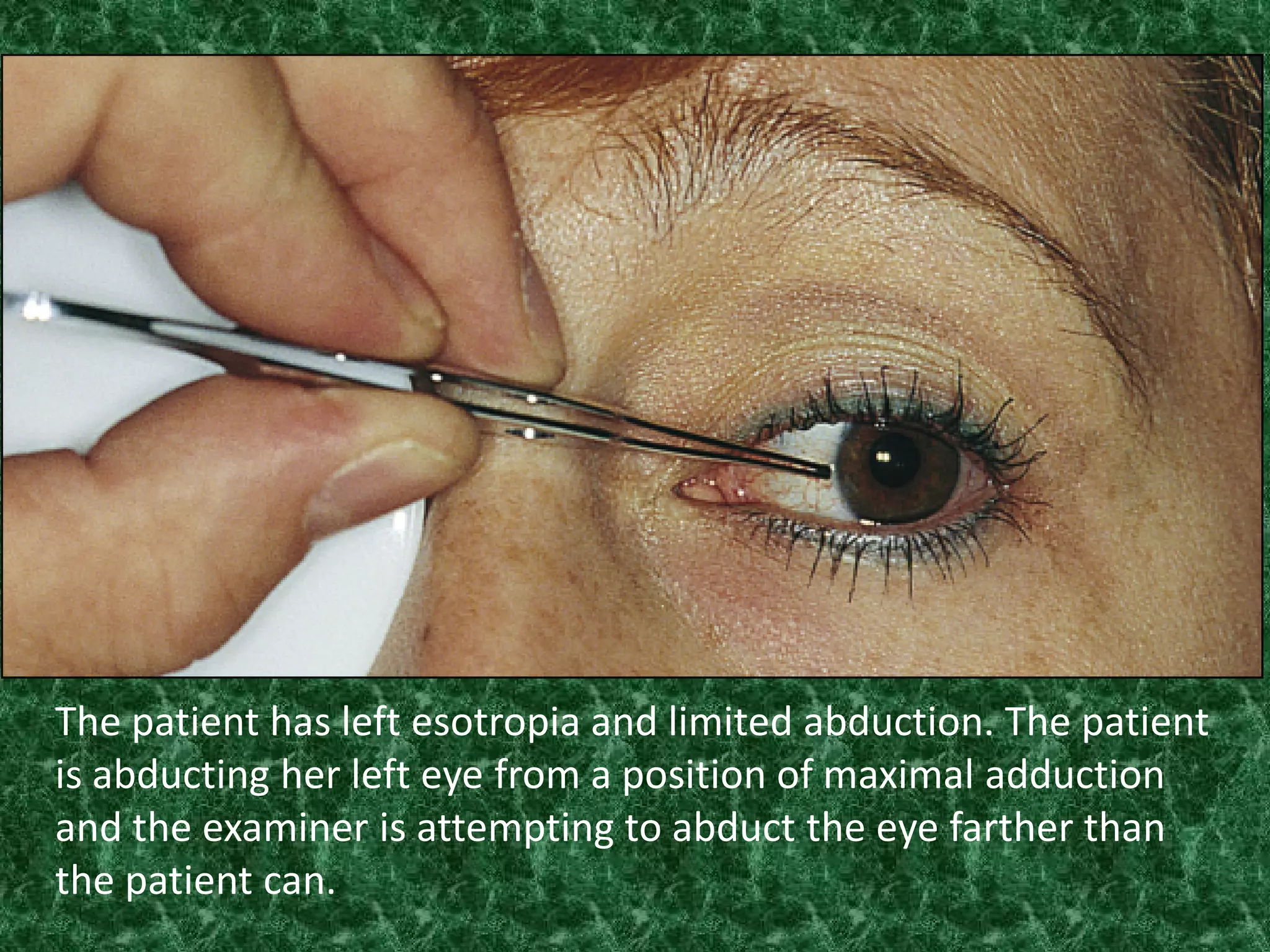 The patient has left esotropia and limited abduction. The patient
is abducting her left eye from a position of maximal adduction
and the examiner is attempting to abduct the eye farther than
the patient can.

 