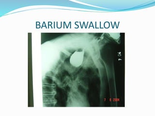 BARIUM SWALLOW
 