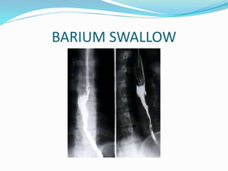 BARIUM SWALLOW
 