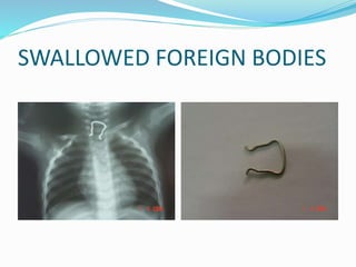 SWALLOWED FOREIGN BODIES
 
