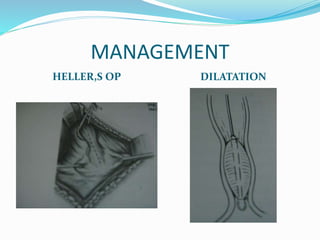 MANAGEMENT
HELLER,S OP DILATATION
 