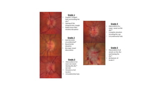 Diseases of optic nerve and it's clinical aspects .pdf