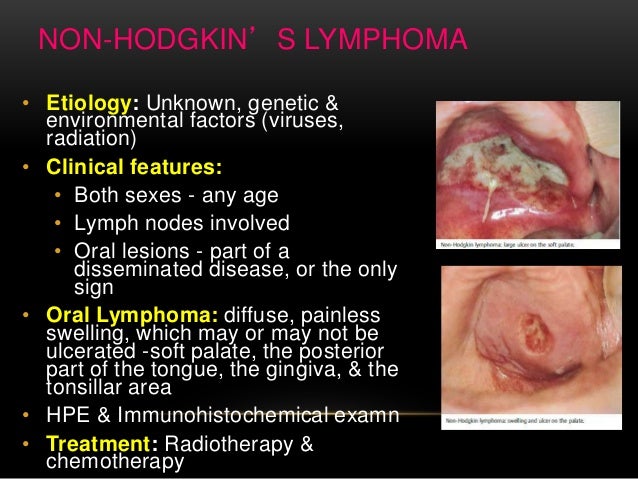 Oral Lesions Lymphoma Symptoms