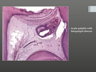 Acute pulpitis with
Intrapulpal abscess

 