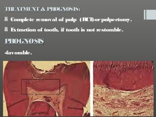 TREATMENT & PROGNOSIS:
Complete removal of pulp (RCT pulpectomy.
)or
E
xtraction of tooth, if tooth is not restorable.

P
ROGNOSIS
-favorable.

 