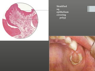 Stratified
sq.
epithelium
covering
polyp

 