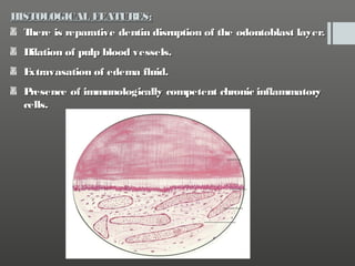 HISTOLOGICAL FEATURES:
T
here is reparative dentin disruption of the odontoblast layer.
Dilation of pulp blood vessels.
E
xtravasation of edema fluid.
P
resence of immunologically competent chronic inflammatory
cells.

 