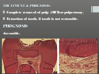 TREATMENT & PROGNOSIS:
Complete removal of pulp (RCT pulpectomy.
)or
E
xtraction of tooth, if tooth is not restorable.

P
...