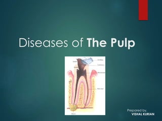 Diseases of The Pulp
Prepared by,
VISHAL KURIAN
 