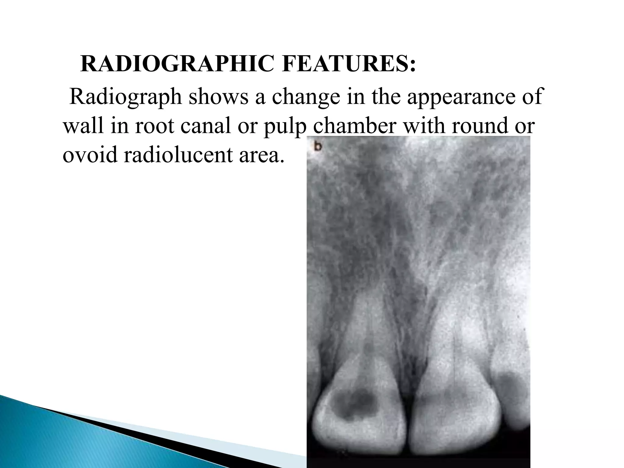 Pulp Radiograph Diseases of pulp | PPTX