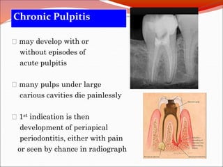 Pulpitis Priapical Diseases of pulp | PPTX