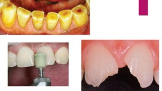 CLASSIFICATION OF THE DISEASES
OF THE PULP
 INFLAMMATORY DISEASES OF THE DENTAL PULP
1) Reversible pulpitis
2) Irreversib...