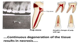 Pulp Bleeding Color Diseases of pulp | PPTX