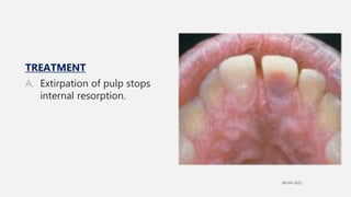 B. PULP DEGENERATION
oPulp degeneration is usually present in teeth of old
people.
oIt may also result in persistent, mild...
