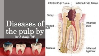 Diseases of
the pulp by
Dr.Ashuja.RB
 