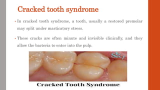Cracked tooth syndrome
• In cracked tooth syndrome, a tooth, usually a restored premolar
may split under masticatory stres...