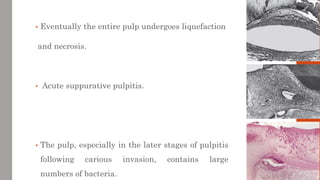 • Eventually the entire pulp undergoes liquefaction
and necrosis.
• Acute suppurative pulpitis.
• The pulp, especially in ...