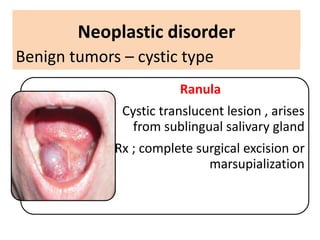 Marsupialization Small Ranula Diseases of salivary gland | PPTX