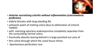 • Anterior necrotizing scleritis without inflammation (scleromalacia
perforans).
• elderly females with long-standing RA.
• yellowish patch of melting sclera (due to obliteration of arterial
supply);
• with overlying episclera andconjunctiva completely separates from
the surrounding normal sclera.
• Eventually absorbs leaving behind it a large punched out area of
• thin sclera through which the uveal tissue shines
• Spontaneous perforation rare
 