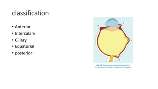 classification
• Anterior
• Intercalary
• Ciliary
• Equatorial
• posterior
 