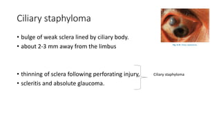 Ciliary staphyloma
• bulge of weak sclera lined by ciliary body.
• about 2-3 mm away from the limbus
• thinning of sclera following perforating injury,
• scleritis and absolute glaucoma.
Ciliary staphyloma
 