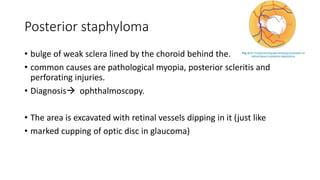 Posterior staphyloma
• bulge of weak sclera lined by the choroid behind the.
• common causes are pathological myopia, posterior scleritis and
perforating injuries.
• Diagnosis ophthalmoscopy.
• The area is excavated with retinal vessels dipping in it (just like
• marked cupping of optic disc in glaucoma)
 