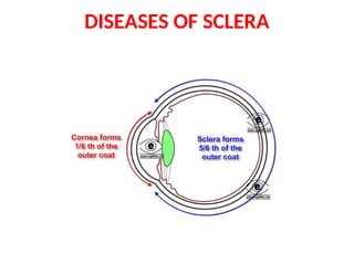 Diseases of sclera.ppt scleritis is an inflammatory disease | PPT