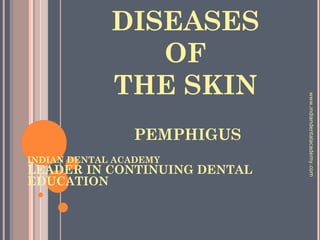 DISEASES
OF
THE SKIN
PEMPHIGUS
INDIAN DENTAL ACADEMY
LEADER IN CONTINUING DENTAL
EDUCATION
www.indiandentalacademy.com
 