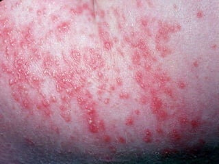 Haole Rot Diseases of skin.... more | PPT